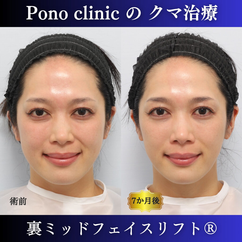 30代女性の裏ミッドフェイスリフト術前・術後7か月の笑顔比較