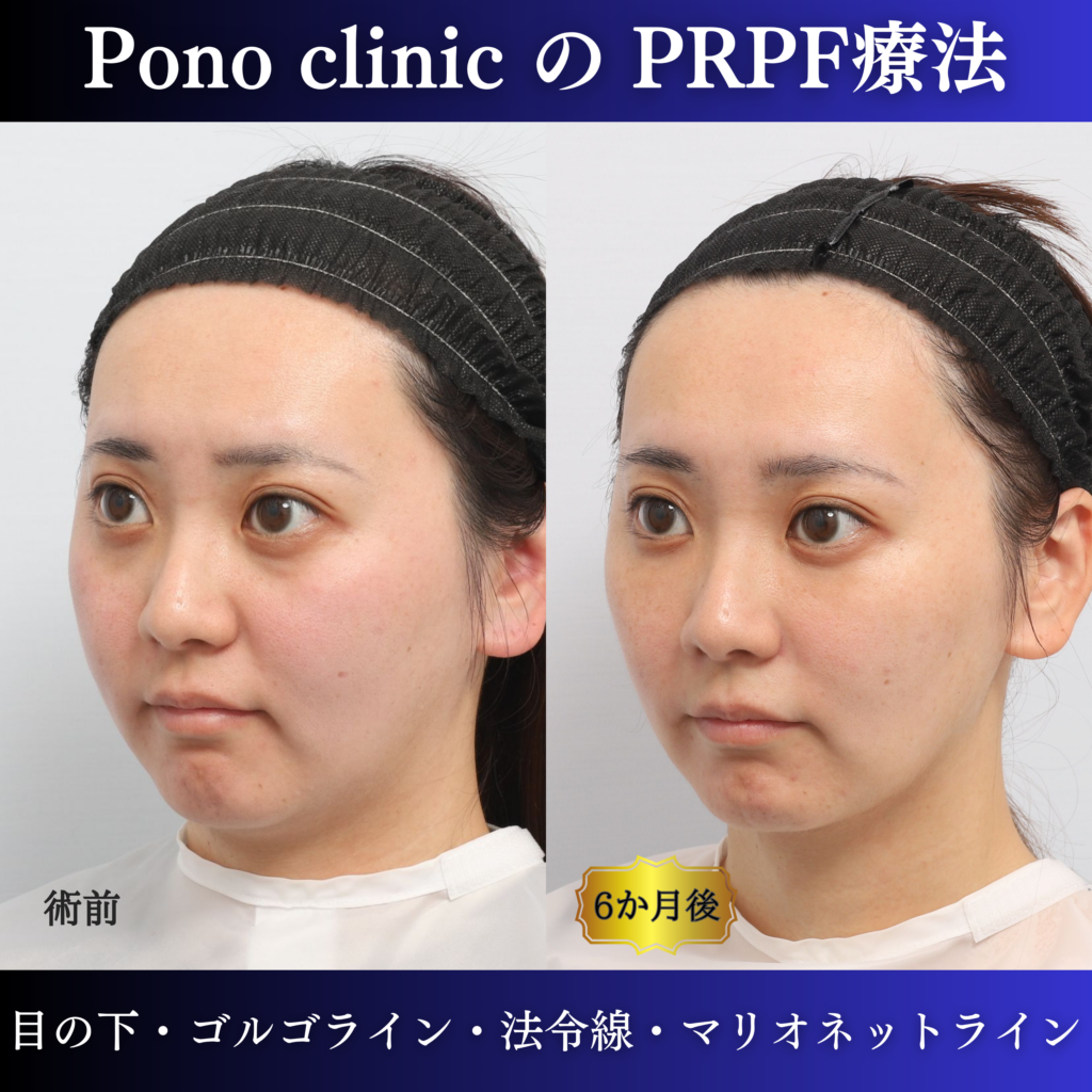 PRPF®療法前と治療後6か月を左斜位で比較した症例写真