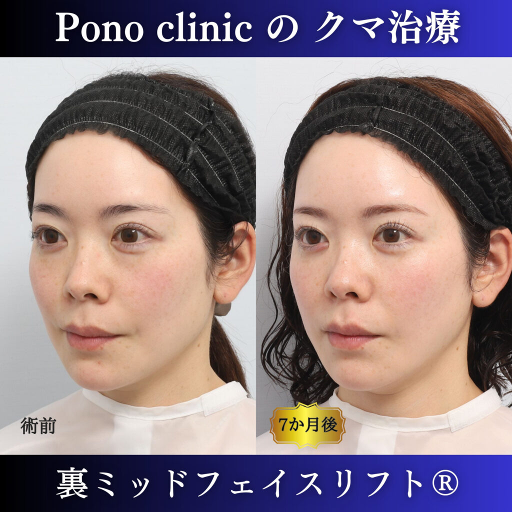 裏ミッドフェイスリフト前と術後6か月を左斜位で比較した症例写真