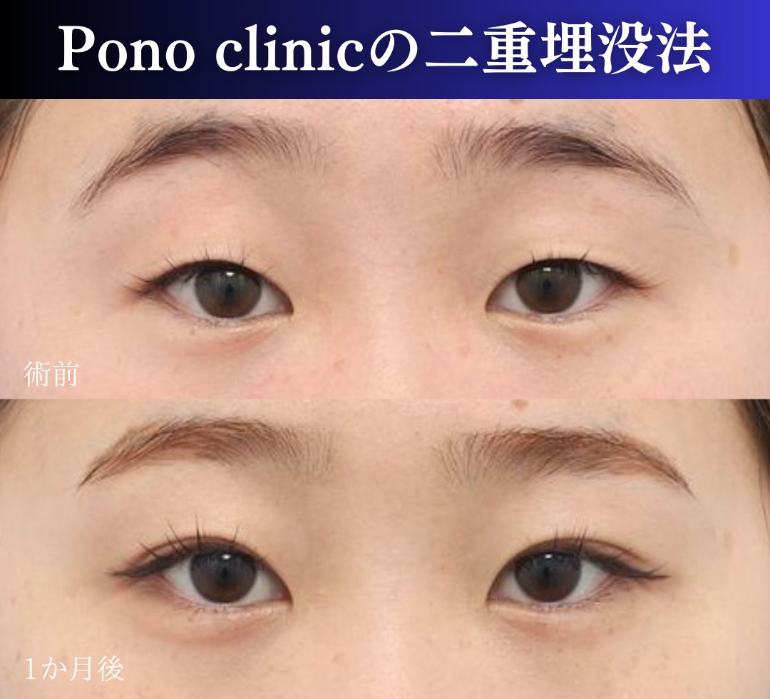 二重・目元整形 - 新宿の美容外科・美容皮膚科ならPonoクリニック