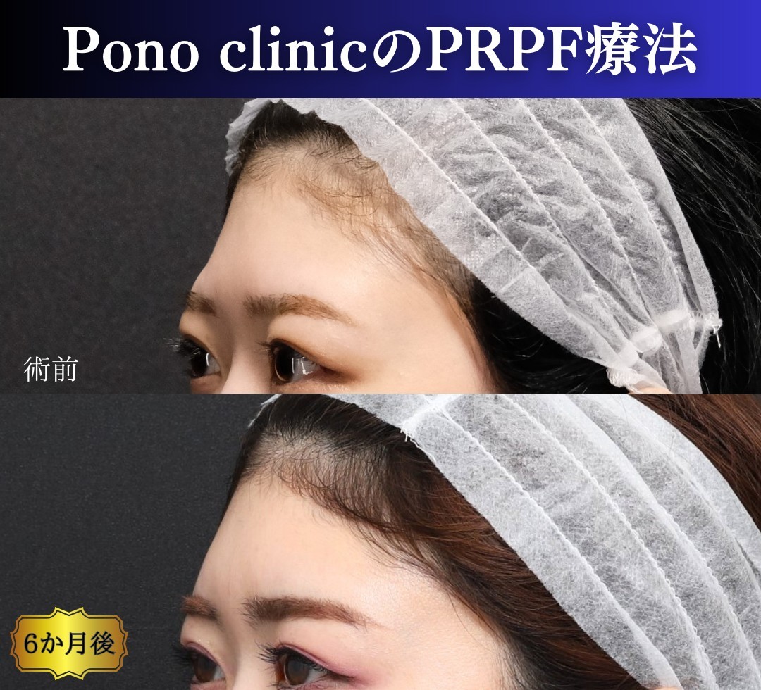 PRPF®療法術前術後02