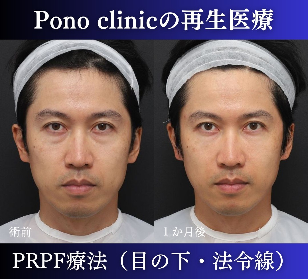 PRPF®療法術前術後03