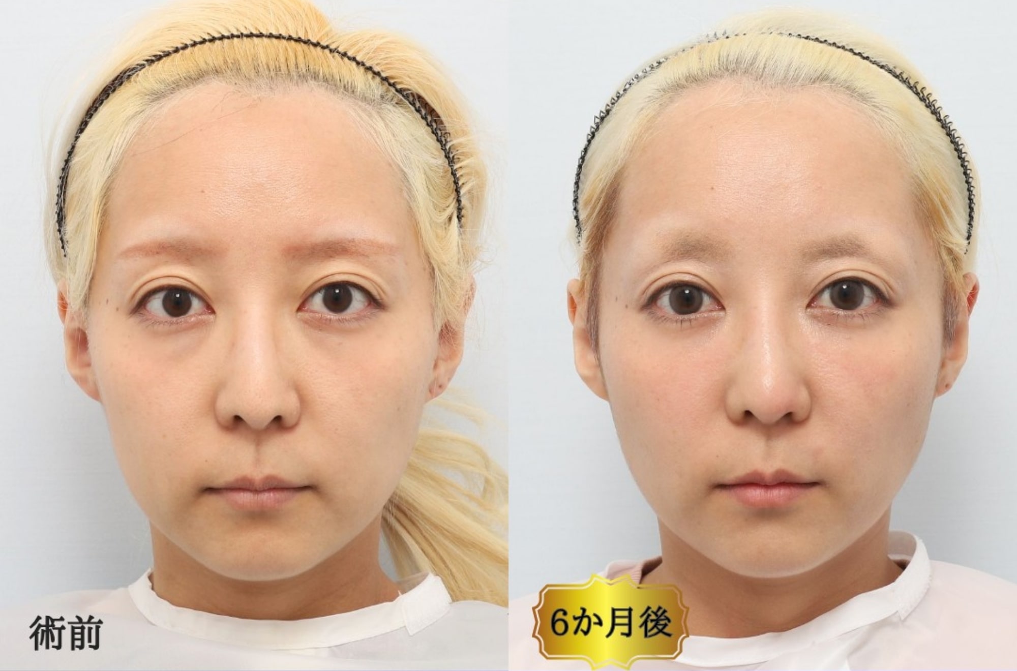 CASE1：裏ミッドフェイスリフト®