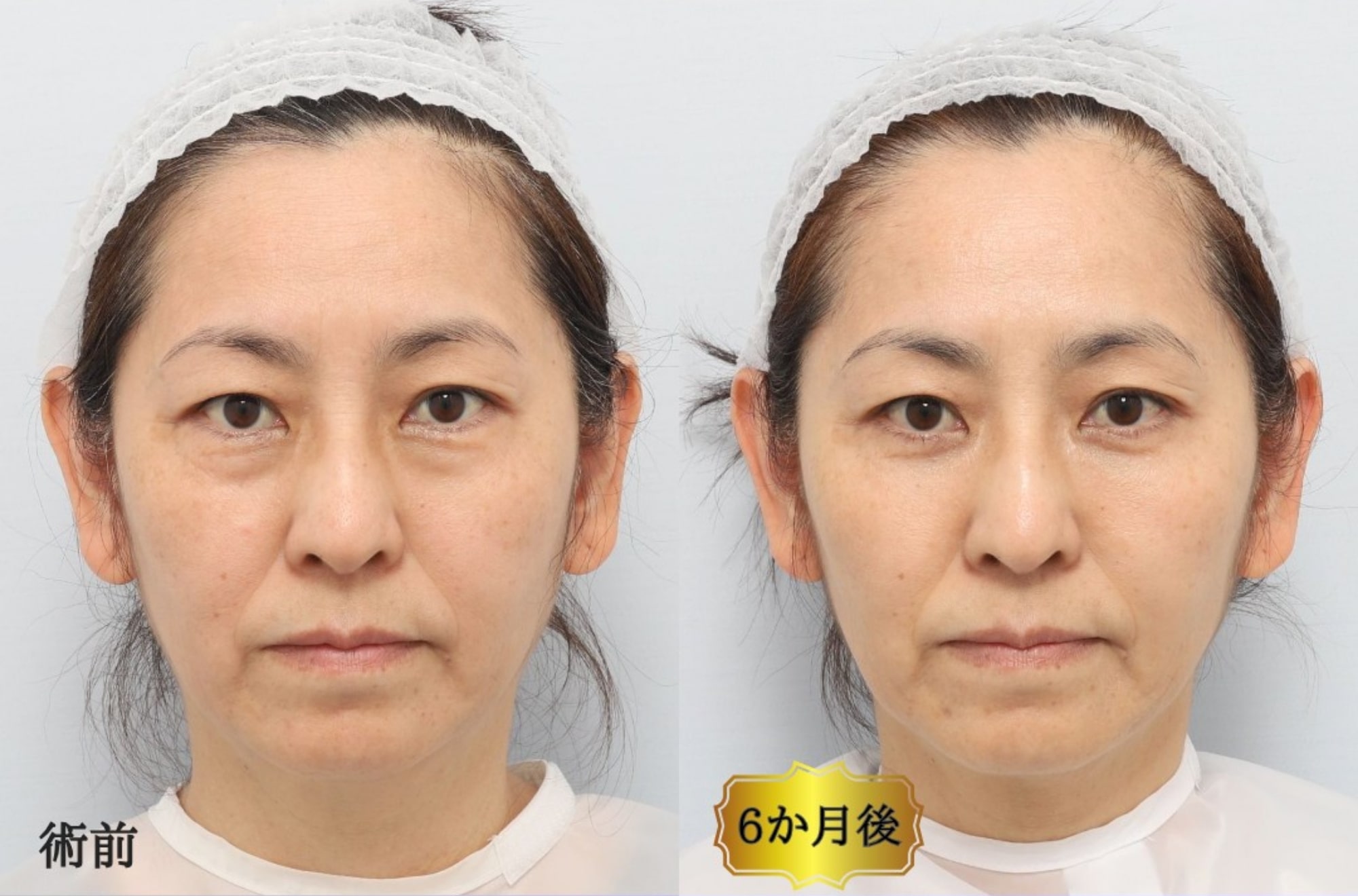 CASE2：裏ミッドフェイスリフト®