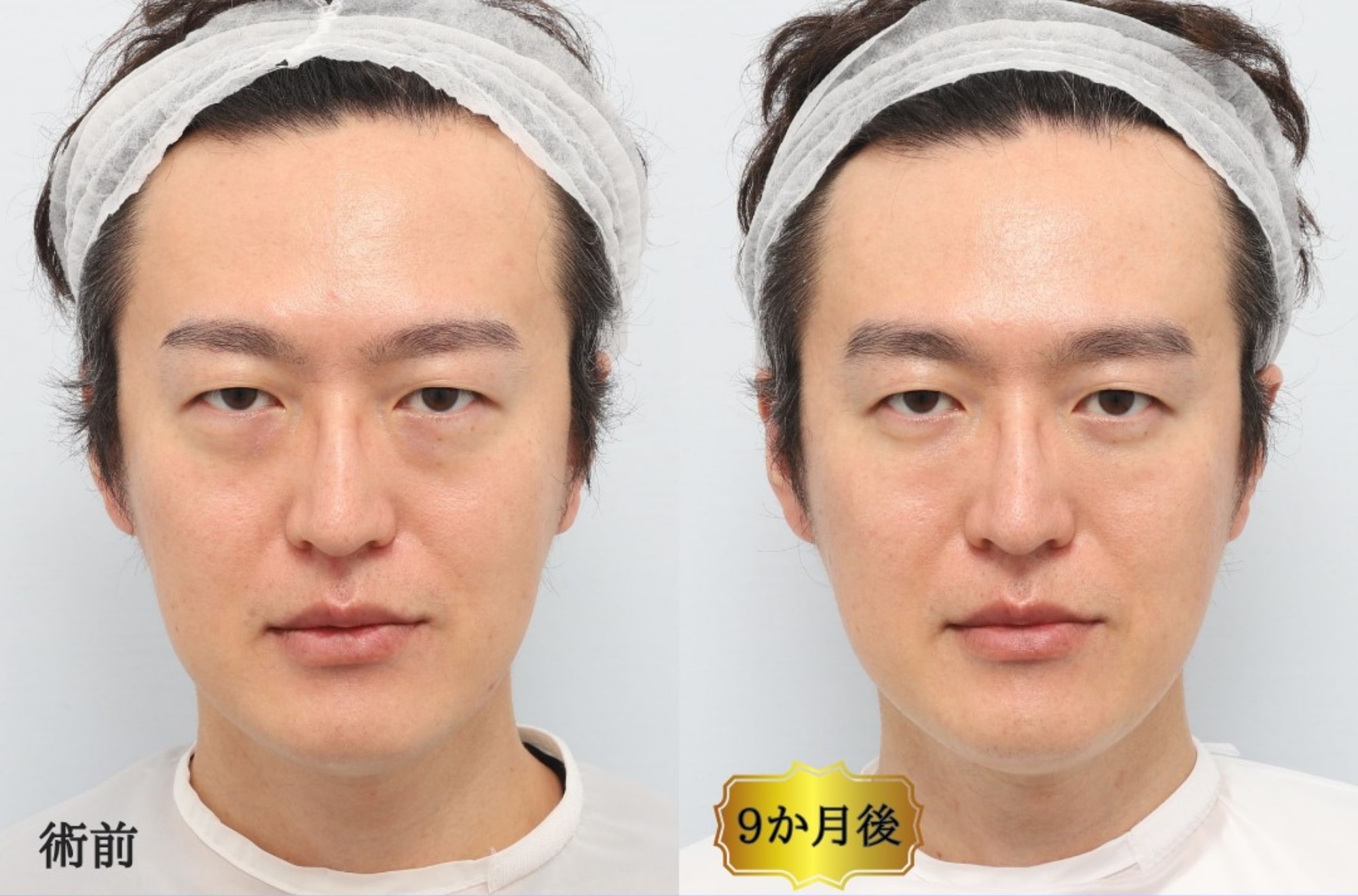 CASE3：裏ミッドフェイスリフト®