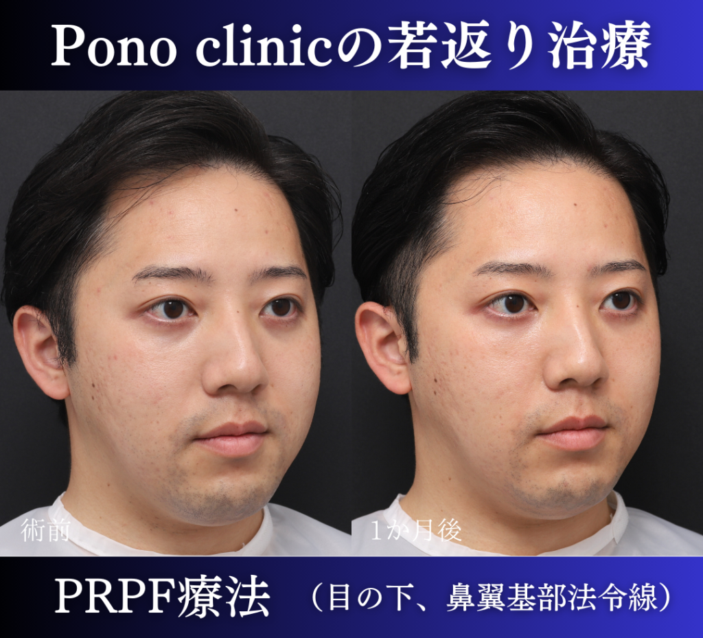PRPF療法、目の下・鼻翼基部法令線の症例、1か月後 (1)