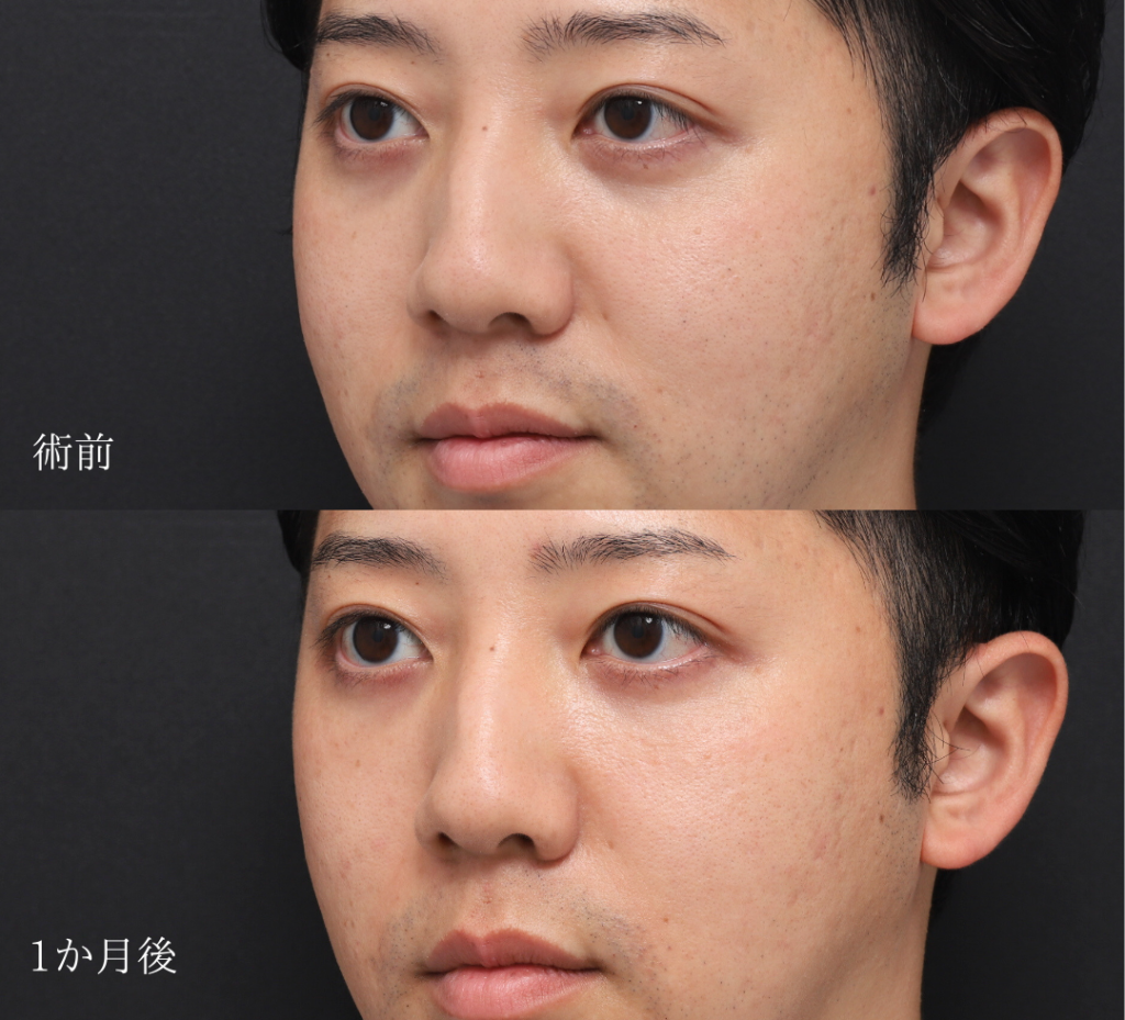 PRPF療法、目の下・鼻翼基部法令線の症例、1か月後 (2)