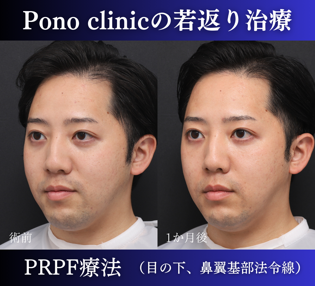 PRPF療法、目の下・鼻翼基部法令線の症例、1か月後 (3)