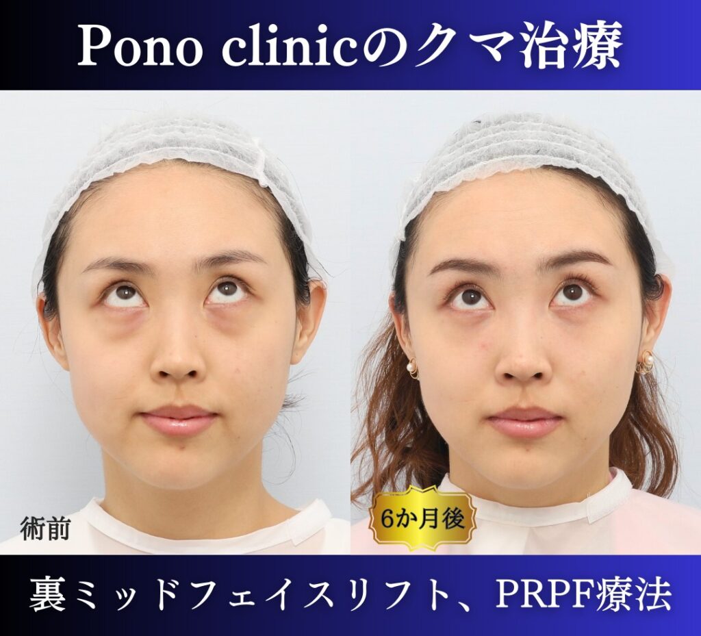 裏ハムラ、ミッドフェイスリフト、PRPF療法目の下の症例、9か月後 上目線