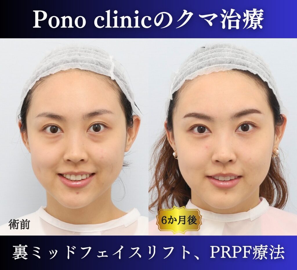 裏ハムラ、ミッドフェイスリフト、PRPF療法目の下の症例、9か月後 笑顔