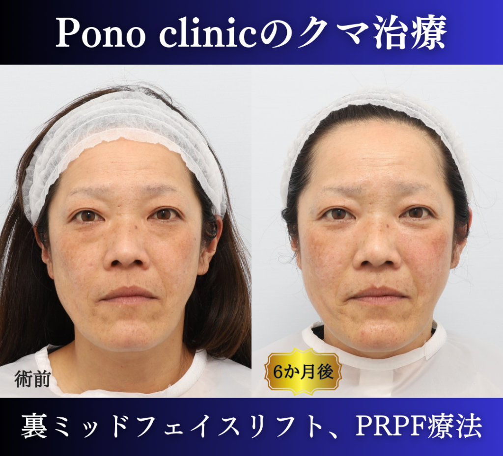 裏ハムラ、ミッドフェイスリフト、頬のPRPF療法の症例 (1)