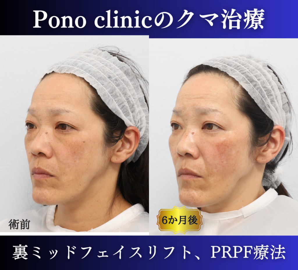 裏ハムラ、ミッドフェイスリフト、頬のPRPF療法の症例 (2)