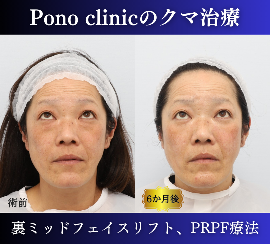 裏ハムラ、ミッドフェイスリフト、頬のPRPF療法の症例 (3)