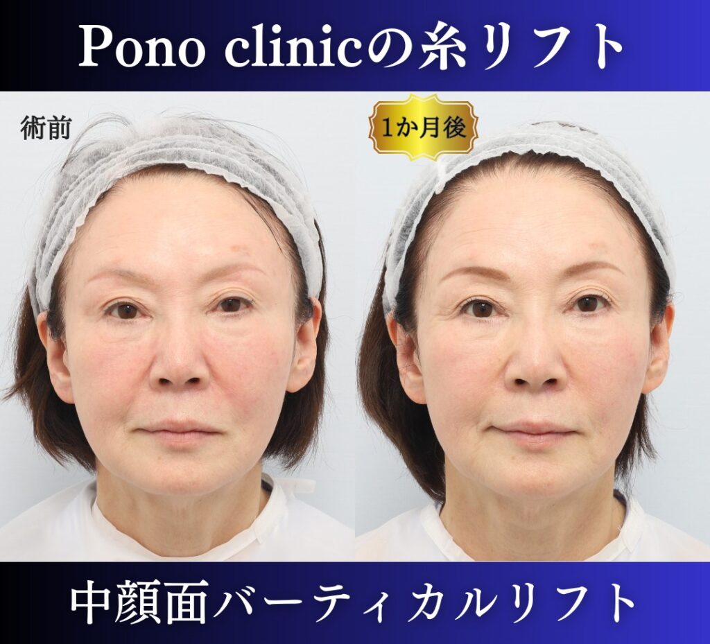 中顔面バーティカルリフトの症例、PCLLA6本使用 (1)