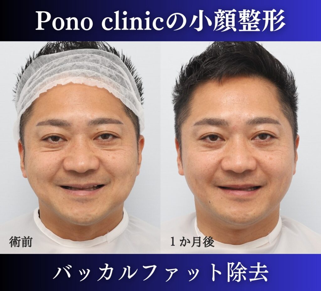 男性の小顔整形、バッカルファット除去症例 (1)