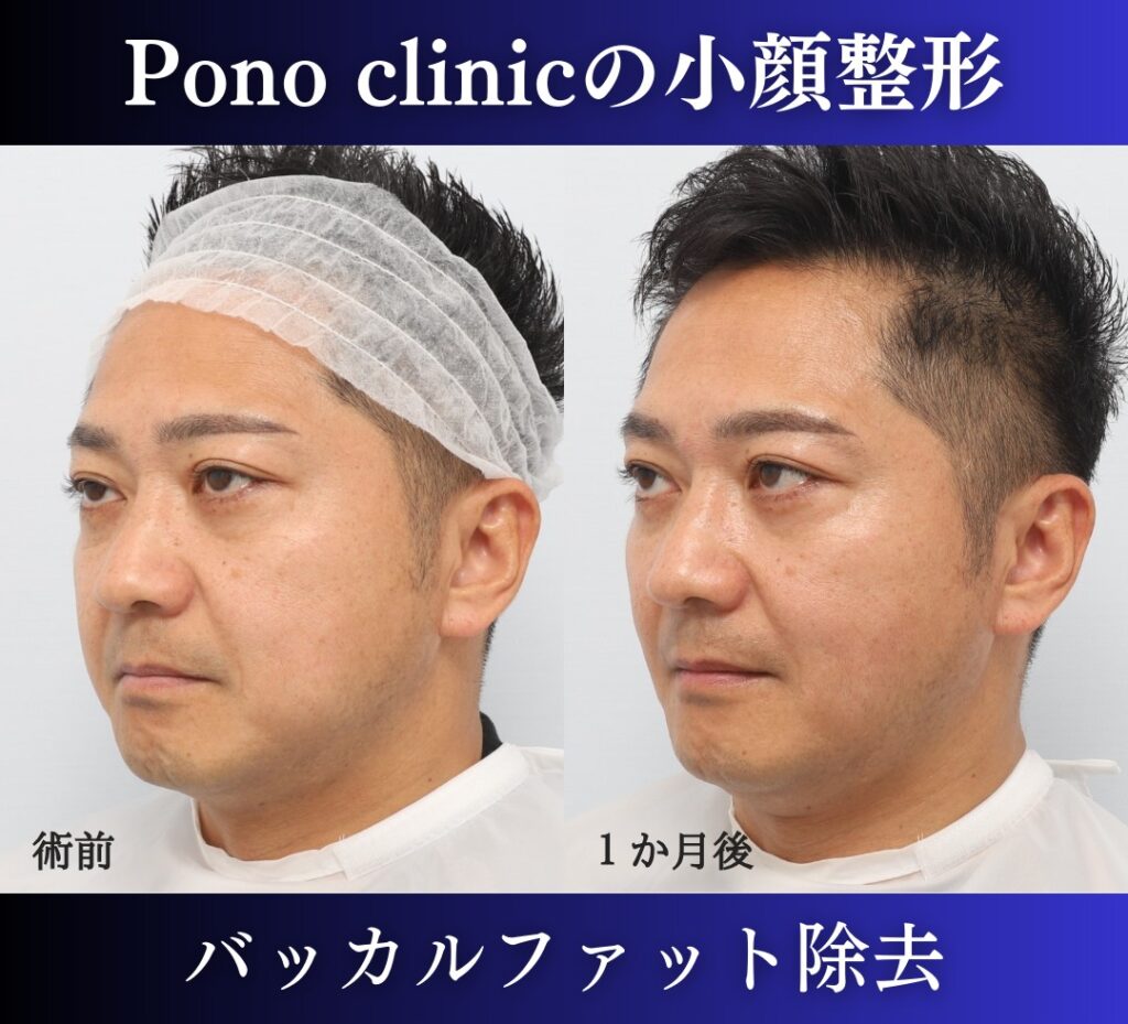 男性の小顔整形、バッカルファット除去症例 (2)