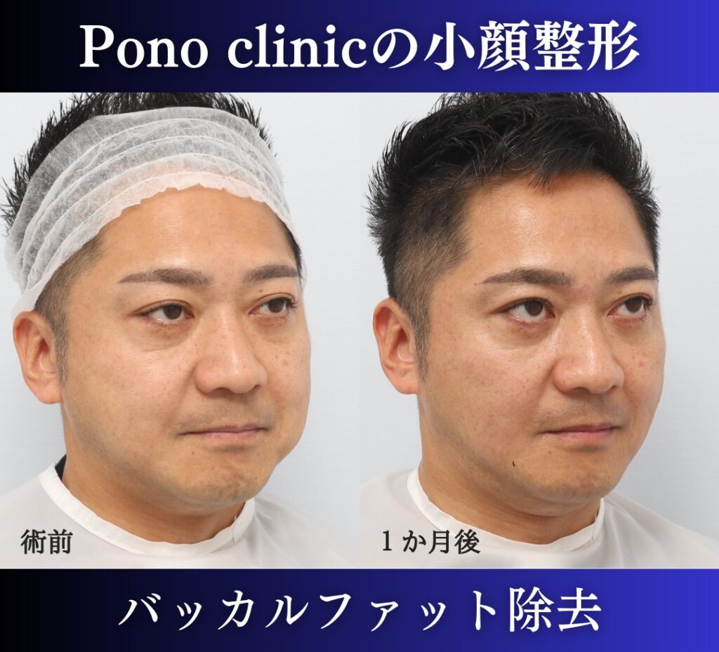 男性の小顔整形、バッカルファット除去症例 (4)