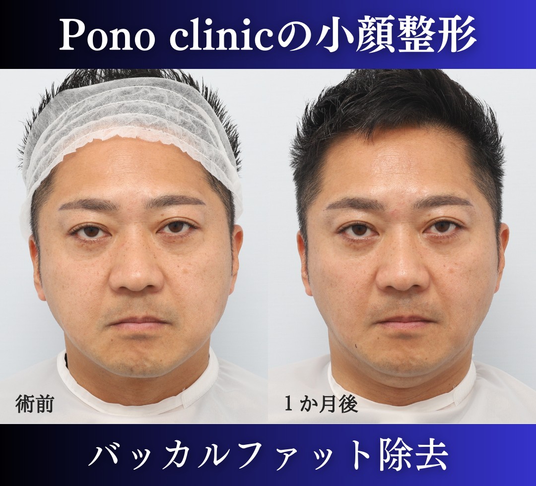 男性の小顔整形、バッカルファット除去症例