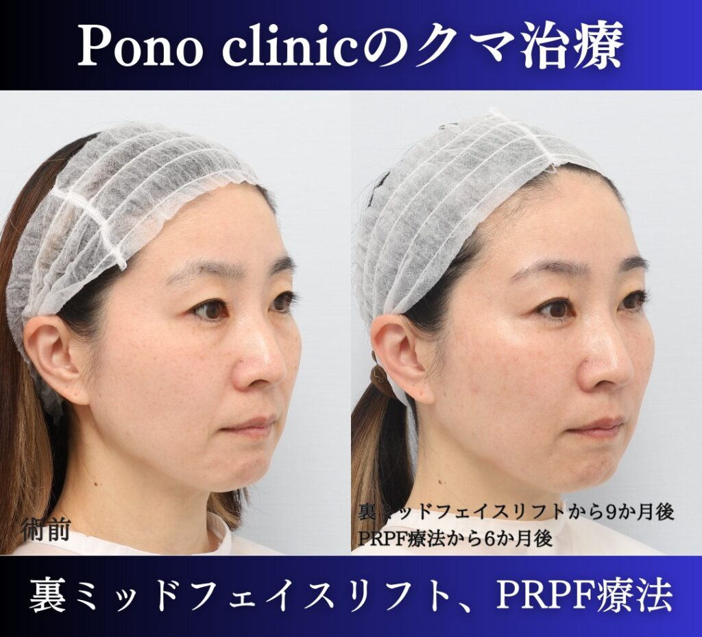 裏ハムラ、ミッドフェイスリフト+PRPF療法の症例 (1)