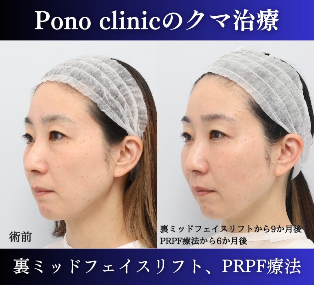 裏ハムラ、ミッドフェイスリフト+PRPF療法の症例 (2)