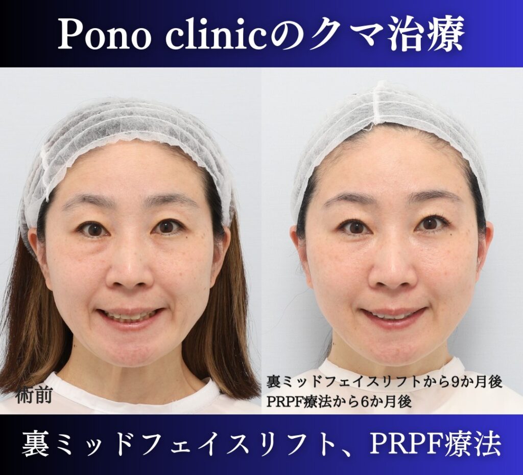 裏ハムラ、ミッドフェイスリフト+PRPF療法の症例 (3)