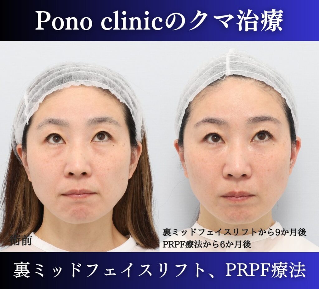 裏ハムラ、ミッドフェイスリフト+PRPF療法の症例 (4)