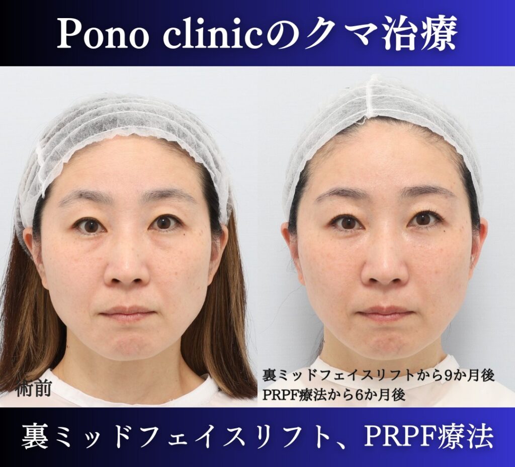 裏ハムラ、ミッドフェイスリフト+PRPF療法の症例 (5)