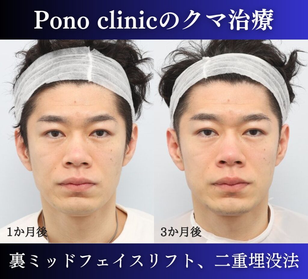 裏ハムラ、ミッドフェイスリフト、二重埋没法の症例30代男性 (6)