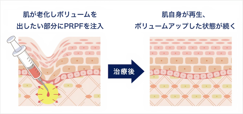 PRPF療法