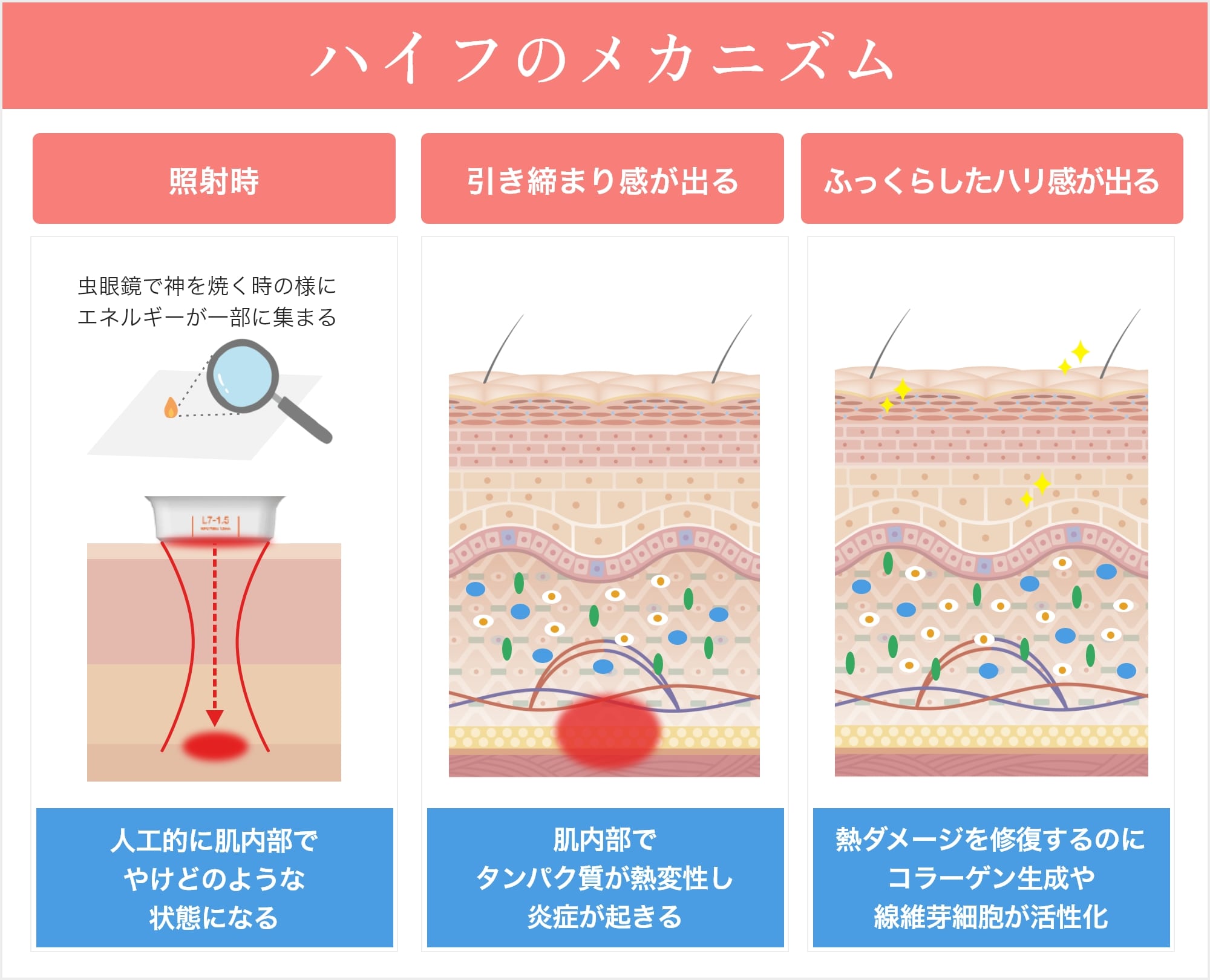 ハイフのメカニズム