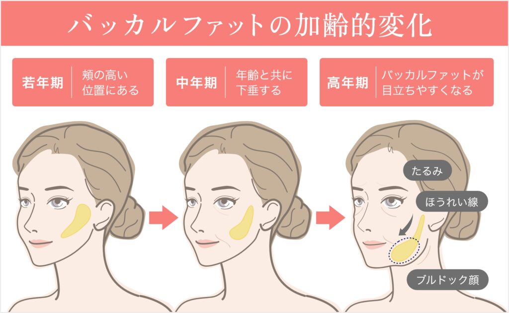 バッカルファットの加齢的変化