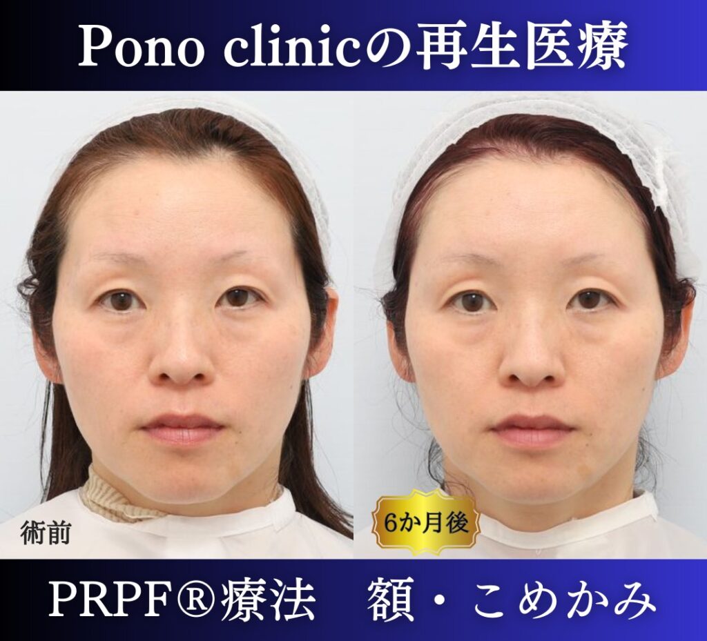 PRPF®療法（額・こめかみ）、40代の症例 (1)