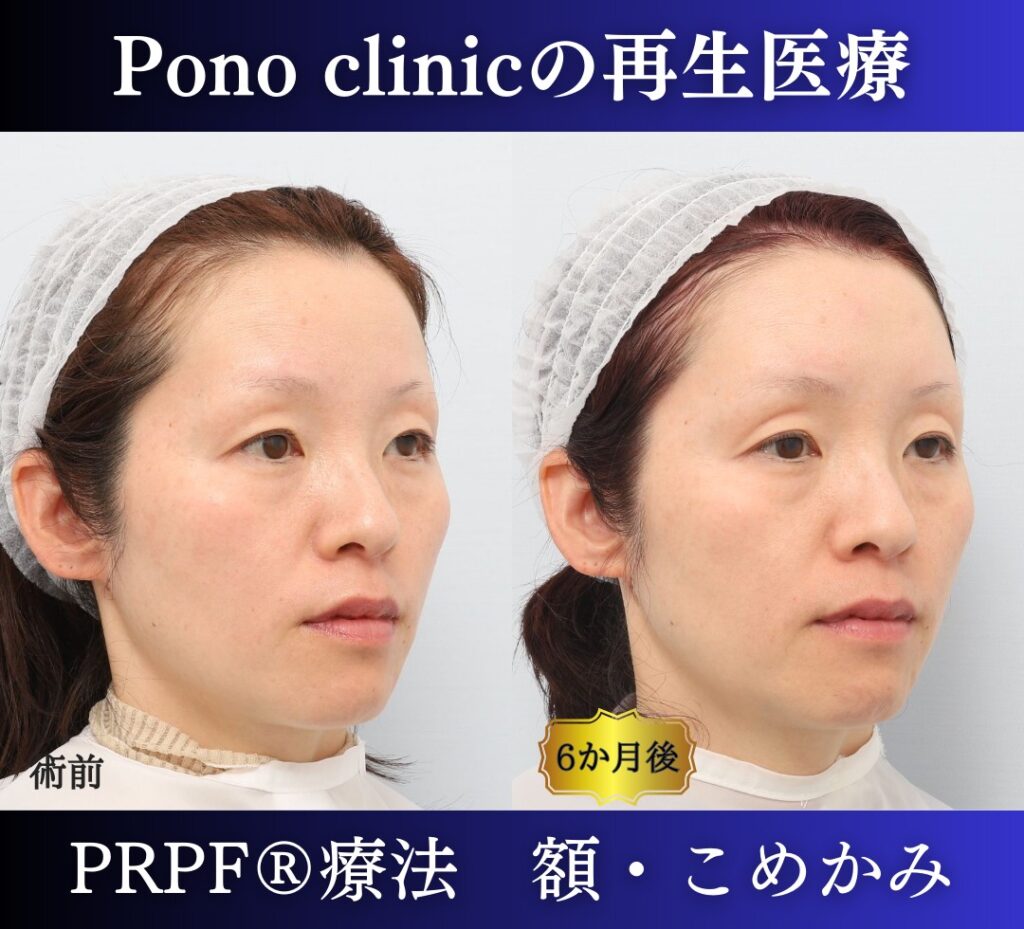 PRPF®療法（額・こめかみ）、40代の症例 (2)