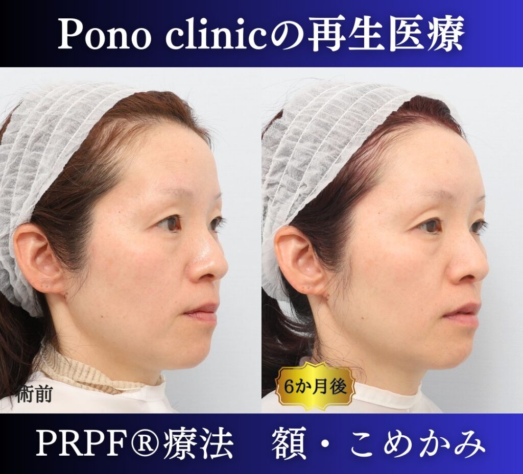 PRPF®療法（額・こめかみ）、40代の症例 (3)