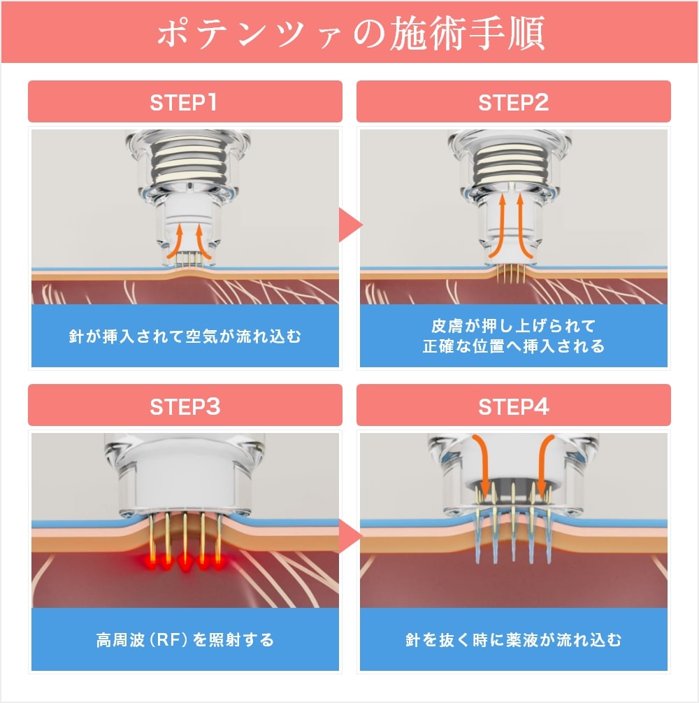 ポテンツァの施術手順