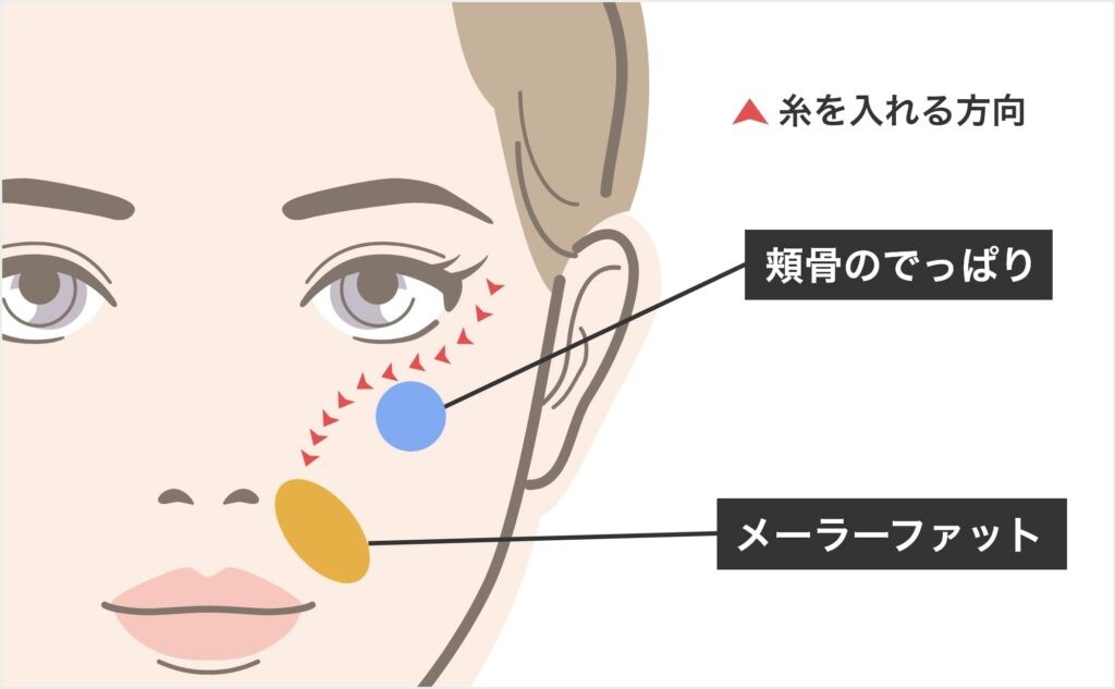 中顔面バーティカルリフト