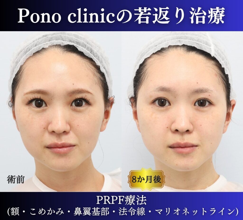 ponoクリニックの若返り治療