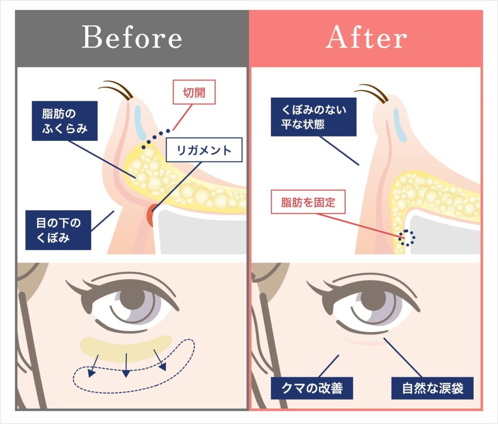 裏ハムラ法