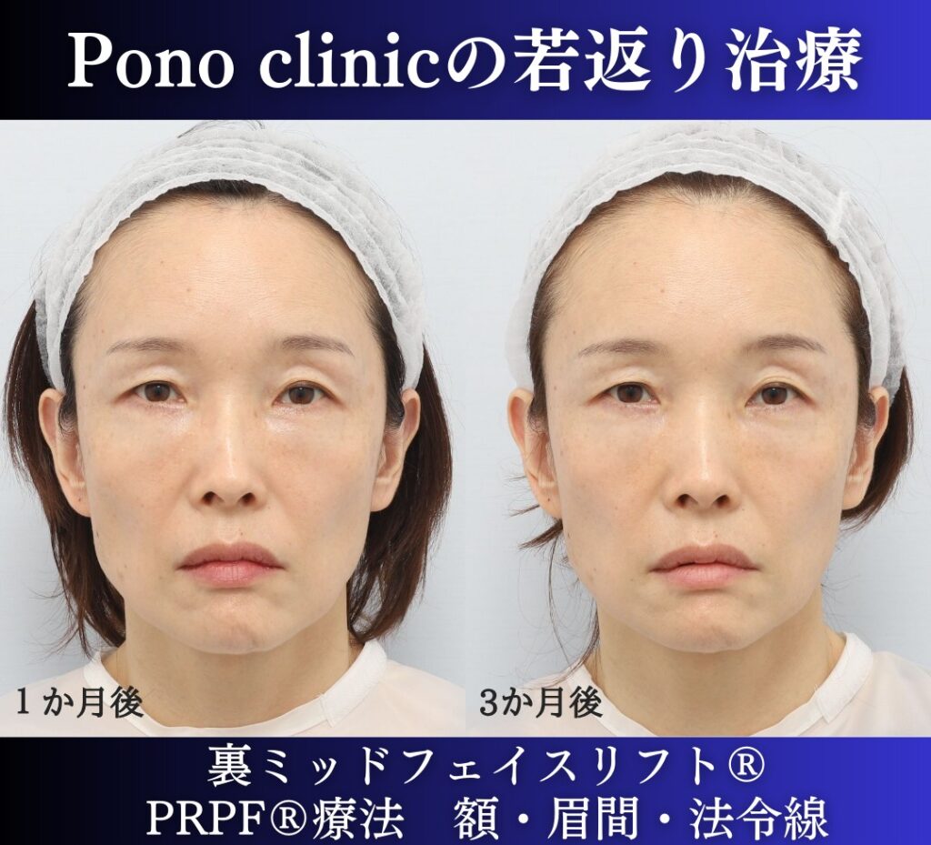 40代の若返り美容、裏ミッドフェイスリフト、PRPF療法の症例 (2)