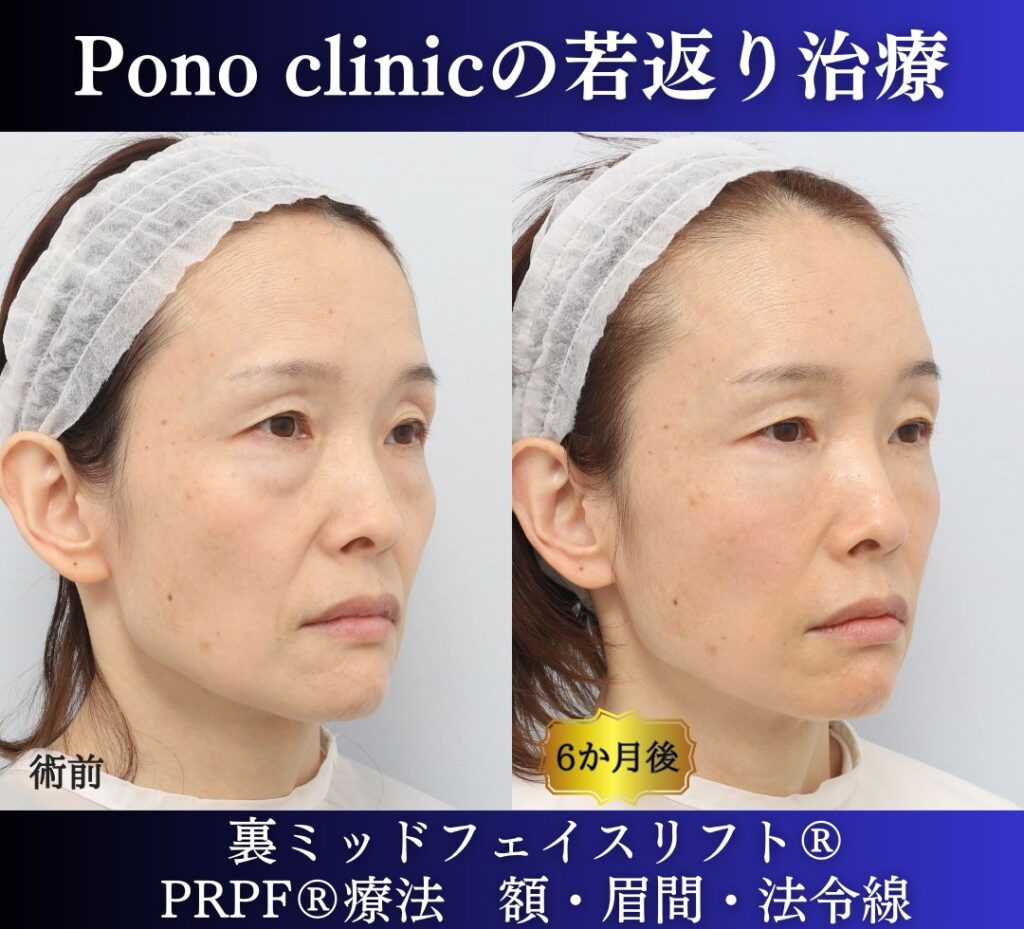 40代の若返り美容、裏ミッドフェイスリフト、PRPF療法の症例 (3)