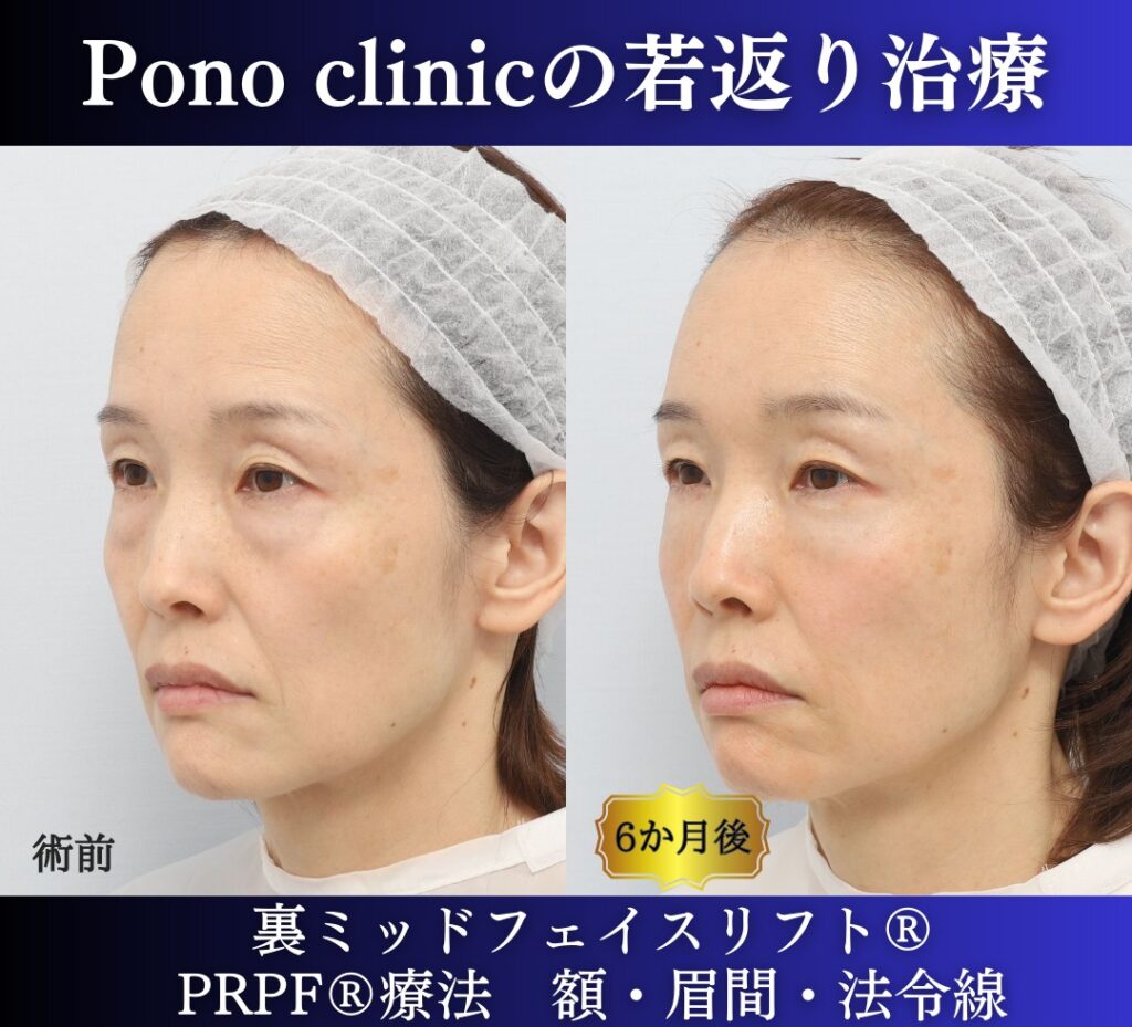 40代の若返り美容、裏ミッドフェイスリフト、PRPF療法の症例 (4)