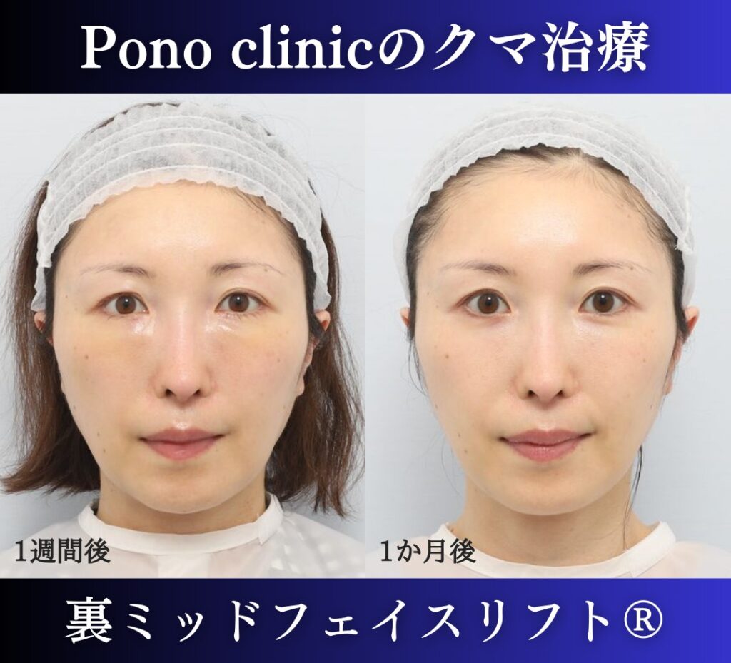 裏ミッドフェイスリフト®+目の上PRPF®療法の症例、40代女性 (1)