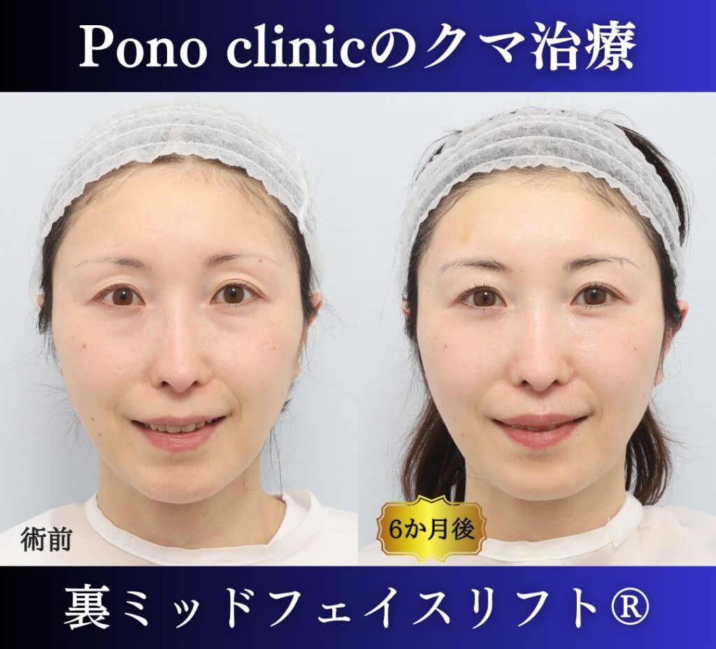 裏ミッドフェイスリフト®+目の上PRPF®療法の症例、40代女性 (4)