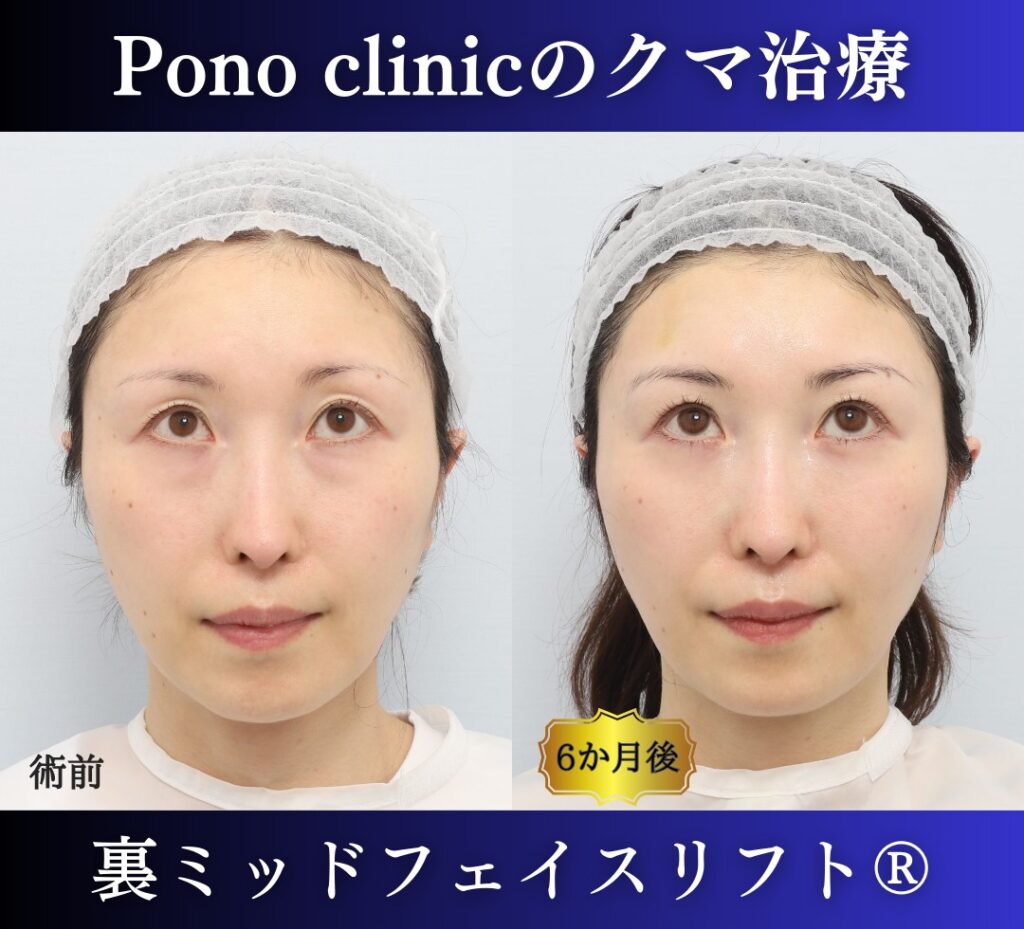 裏ミッドフェイスリフト®+目の上PRPF®療法の症例、40代女性 (6)