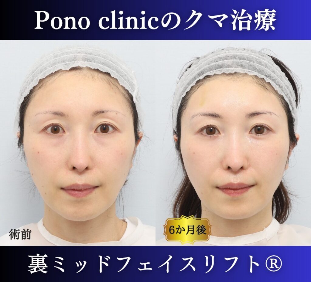 裏ミッドフェイスリフト®+目の上PRPF®療法の症例、40代女性 (7)