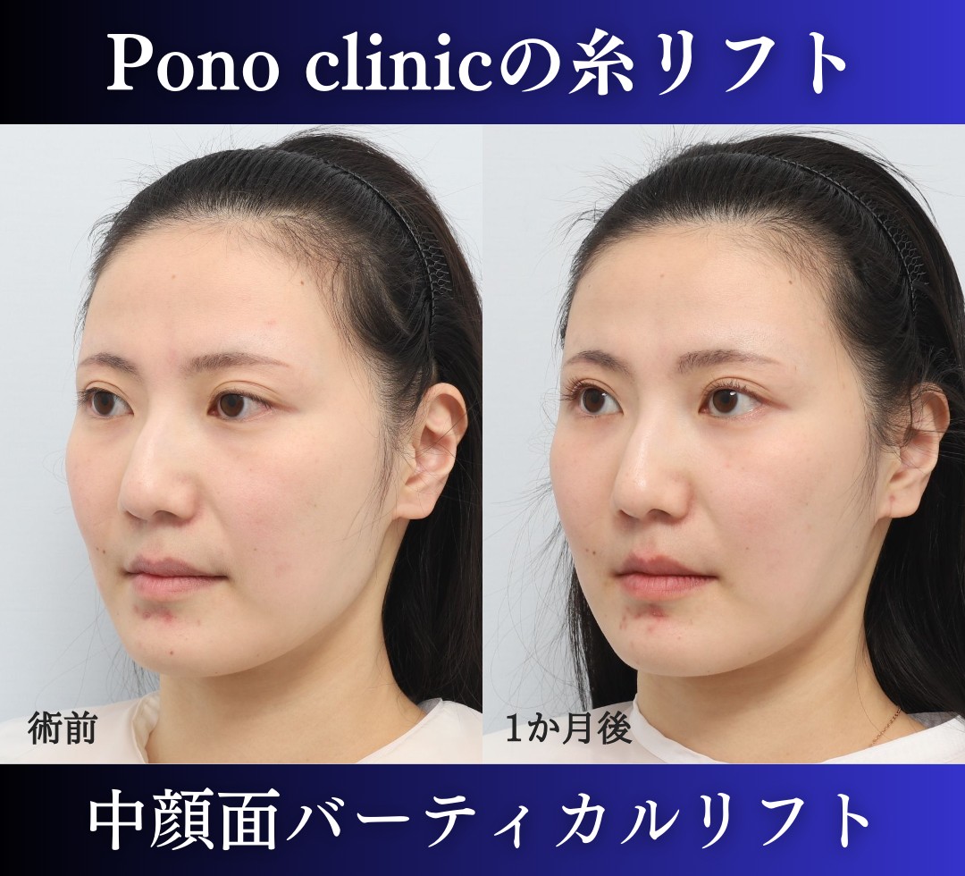 Ponoclinicの30代女性中顔面バーティカルリフトの症例写真