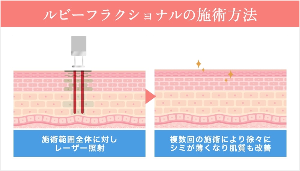 ルビーフラクショナルの施術方法