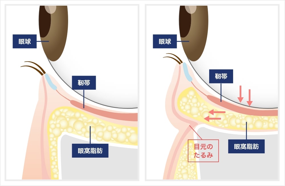 眼の周りの支持靭帯の緩み