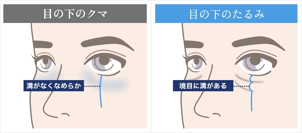 目の下のたるみとクマの違い