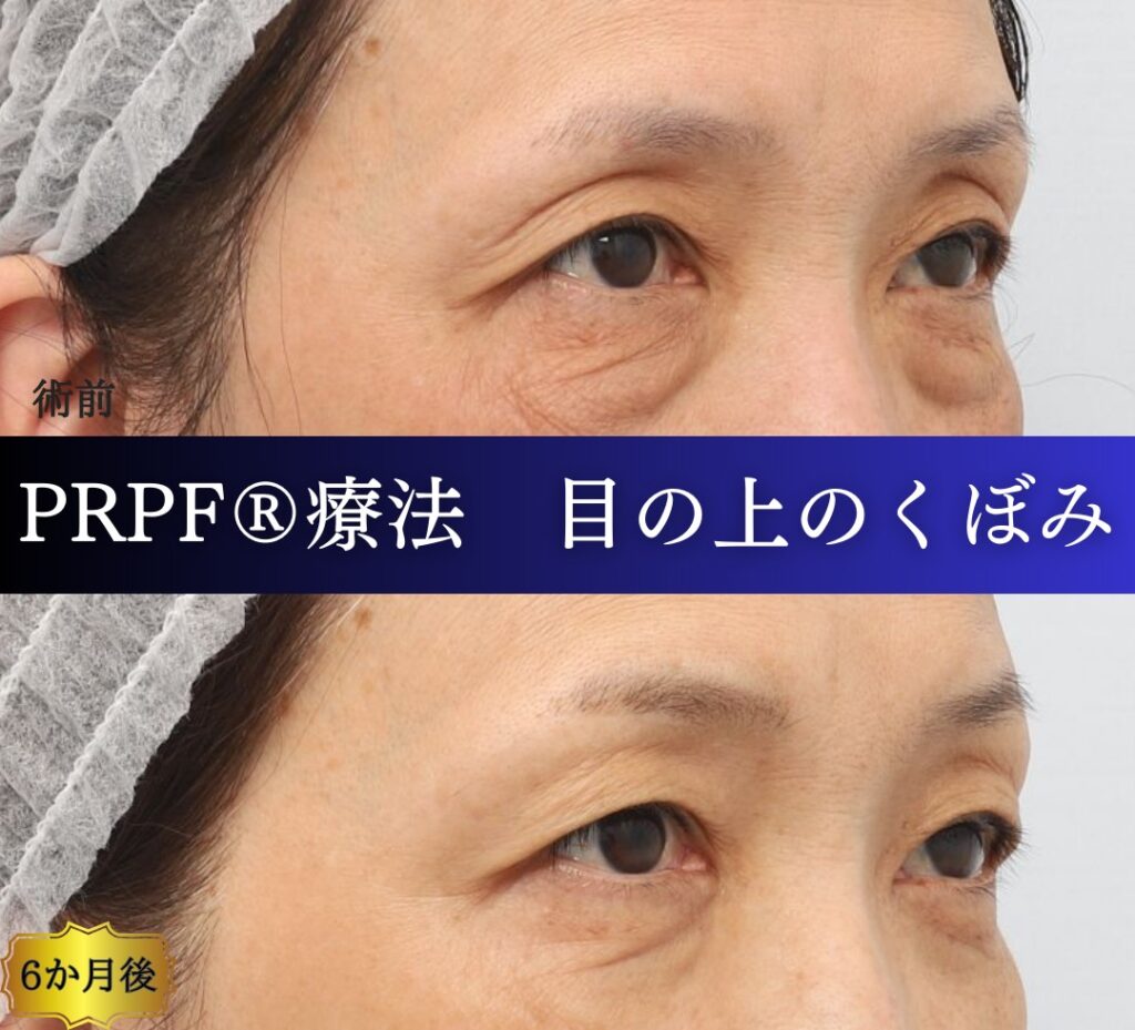 くぼみ目の改善、PRPF療法、50代の症例 (1)